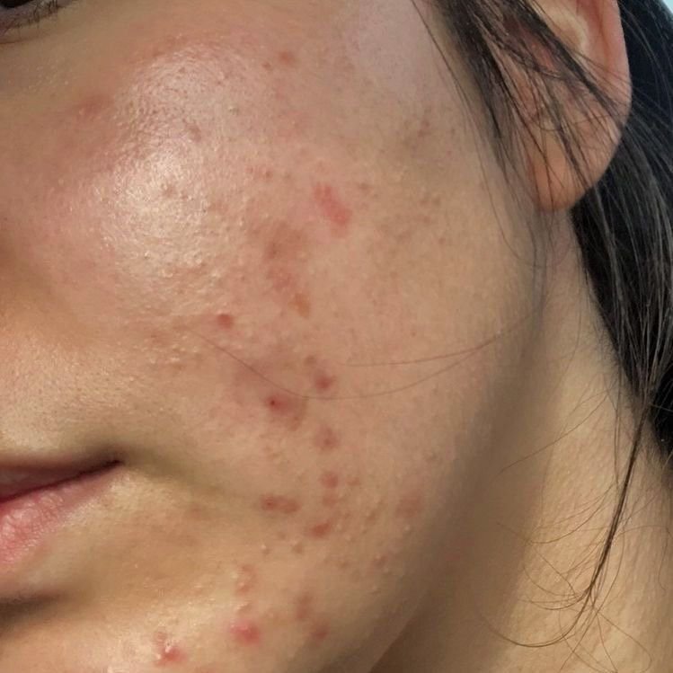 Acne Treatment