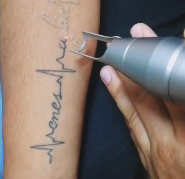 Tattoo Removal Treatment